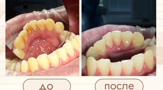 Профессиональная гигиена полости рта