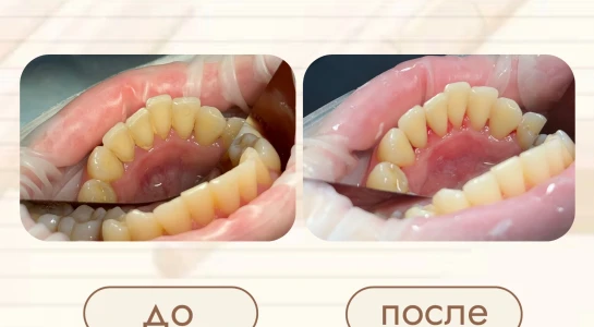 Профессиональная гигиена полости рта