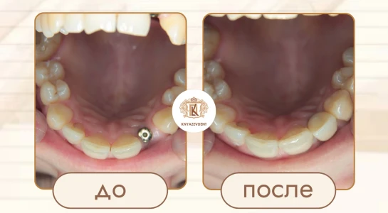Установили имплант Dentium Superline , затем коронка из диоксида циркония