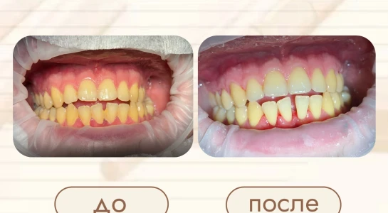 Профессиональная гигиена полости рта