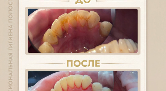 Профессиональная гигиена полости рта