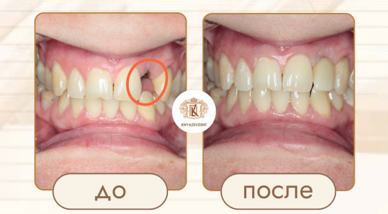Установлен имплантат Dentium Superline, коронка из диоксида циркония